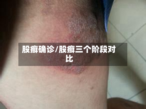 股癣确诊/股癣三个阶段对比-第2张图片