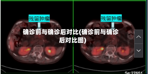 确诊前与确诊后对比(确诊前与确诊后对比图)-第2张图片
