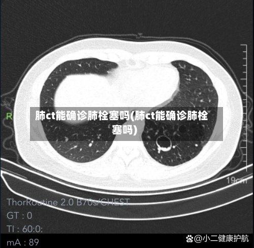 肺ct能确诊肺栓塞吗(肺ct能确诊肺栓塞吗)