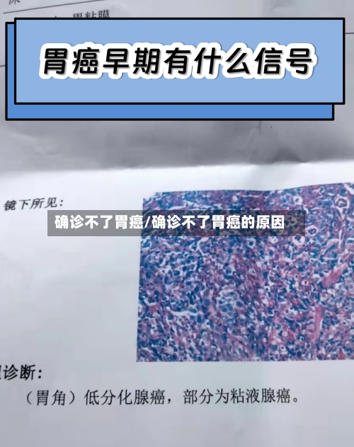 确诊不了胃癌/确诊不了胃癌的原因-第2张图片