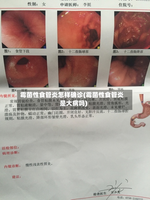 霉菌性食管炎怎样确诊(霉菌性食管炎是大病吗)