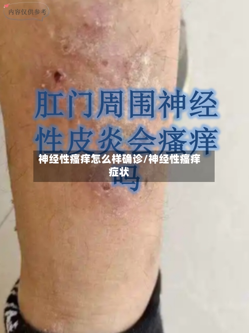 神经性瘙痒怎么样确诊/神经性瘙痒症状-第3张图片