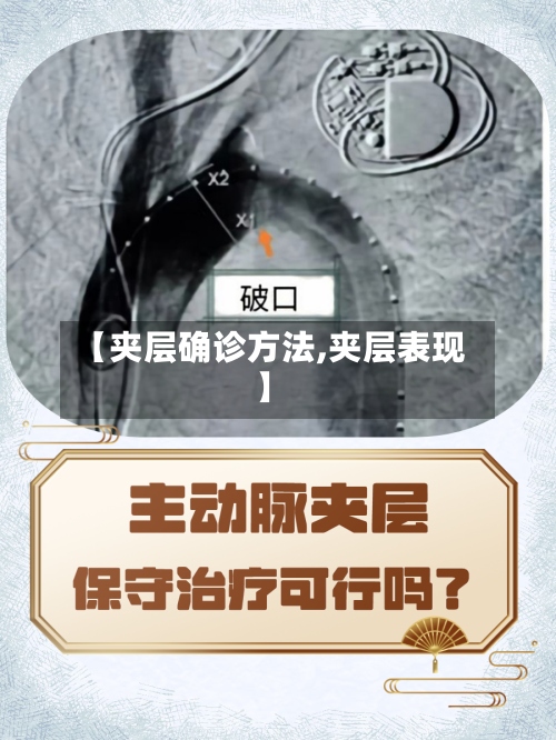 【夹层确诊方法,夹层表现】