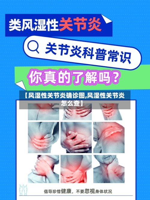 【风湿性关节炎确诊图,风湿性关节炎怎么查】-第2张图片