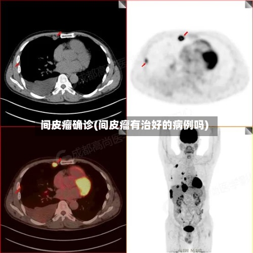 间皮瘤确诊(间皮瘤有治好的病例吗)
