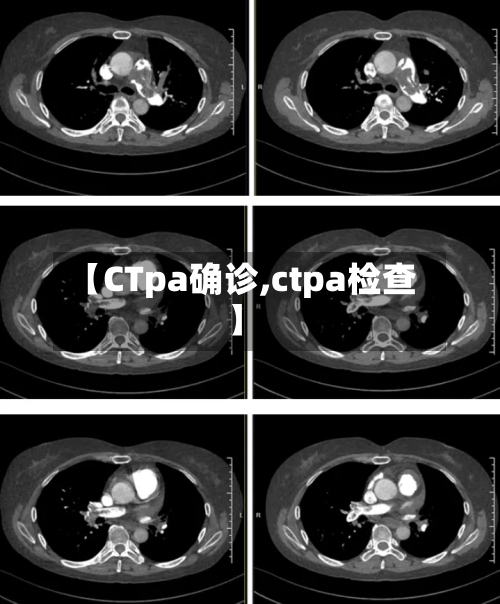 【CTpa确诊,ctpa检查】