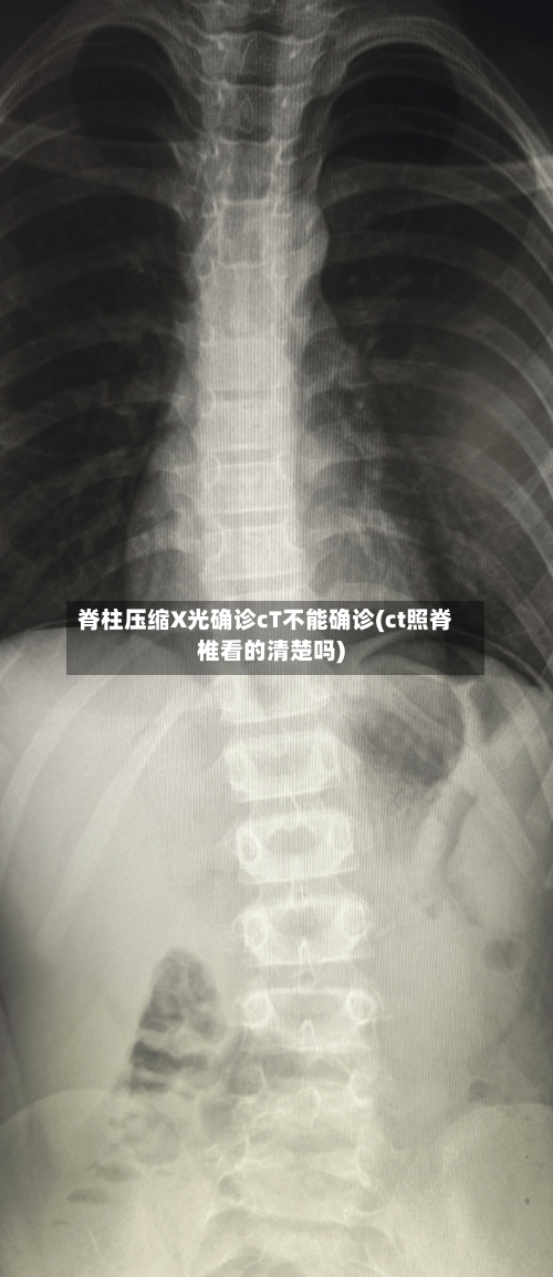 脊柱压缩X光确诊cT不能确诊(ct照脊椎看的清楚吗)