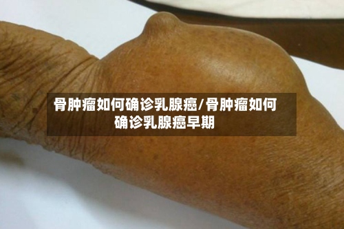 骨肿瘤如何确诊乳腺癌/骨肿瘤如何确诊乳腺癌早期