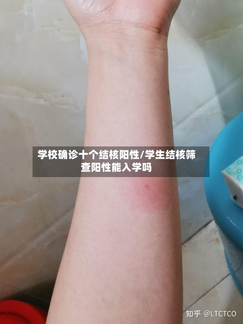 学校确诊十个结核阳性/学生结核筛查阳性能入学吗