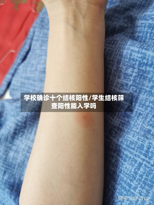 学校确诊十个结核阳性/学生结核筛查阳性能入学吗-第3张图片