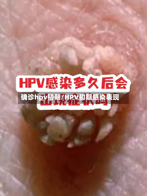 确诊hpv初期/HPV初期感染表现