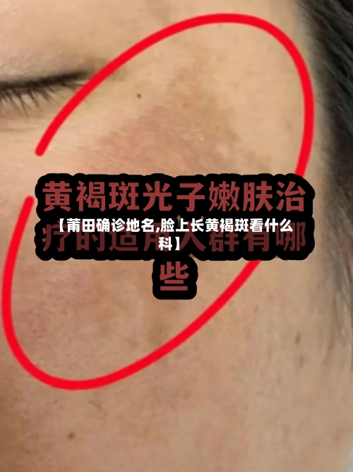【莆田确诊地名,脸上长黄褐斑看什么科】-第2张图片
