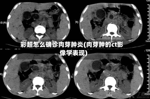 彩超怎么确诊肉芽肿炎(肉芽肿的ct影像学表现)-第2张图片