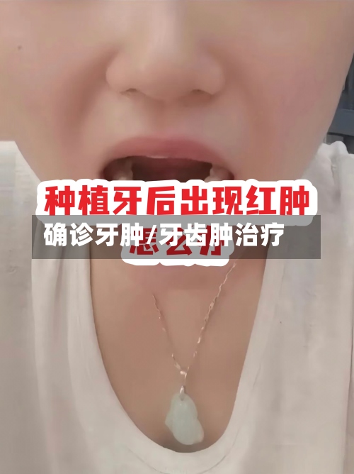 确诊牙肿/牙齿肿治疗-第3张图片